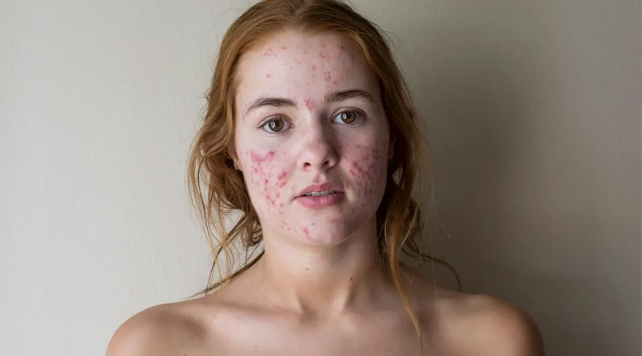 severe acne breakouts